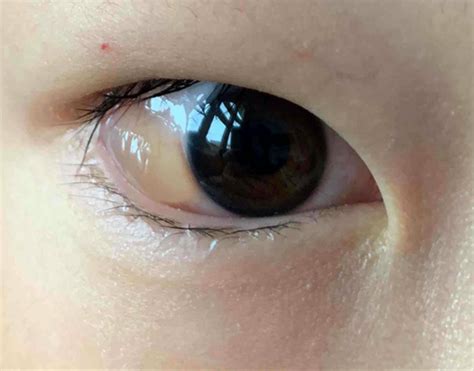 Conjunctival Inclusion Cyst in an 8-Year-Old | Consultant360