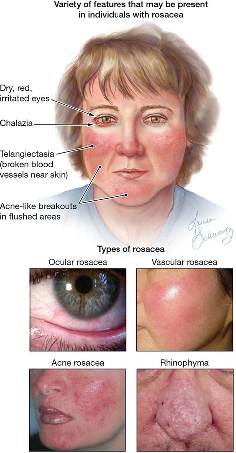 Rosacea. JAMA. 2012;307(21):2333. doi:10.1001/jama.2012.3942. | Rosacea ...