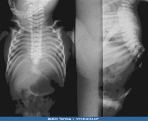 Sacral Agenesis X Ray