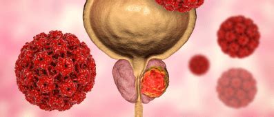 Tremelimumab durvalumab combination shows promise in bladder cancer