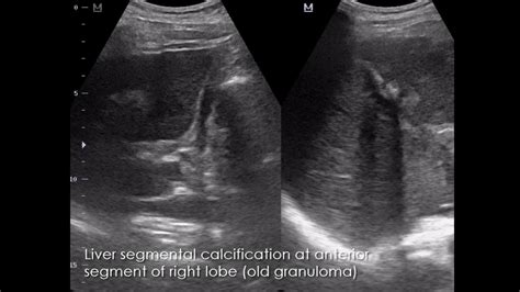 CASE 948 Liver segmental calcification old granuloma - YouTube