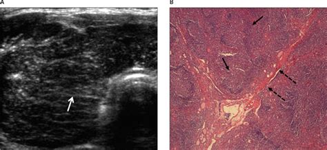 Thyroid Lymphoma - Nam - 2012 - Journal of Ultrasound in Medicine ...