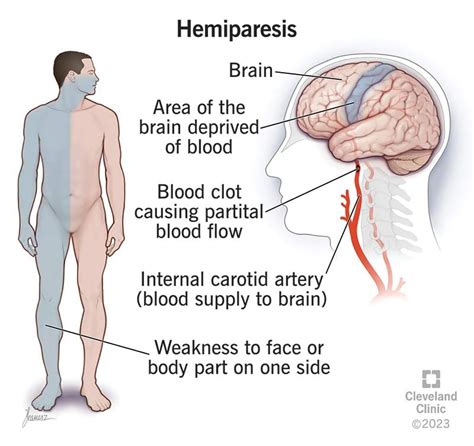 Stroke Patient Hemiparesis