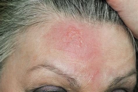 Shingles rash on the forehead - Stock Image - C010/3292 - Science Photo Library