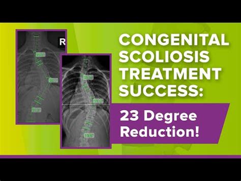 How Is Congenital Scoliosis Diagnosed? Symptoms & Treatment