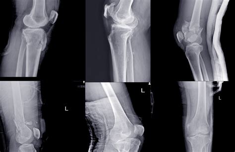 A brief guide to knee fractures - Chris Bailey Orthopaedics