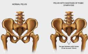 Symphysis Pubis Dysfunction | Musculoskeletal Physiotherapy Australia