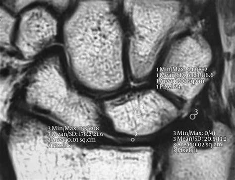 2D T2 BLADE MR Image Demonstrating Examples of ROIs on the Disc of the... | Download Scientific ...