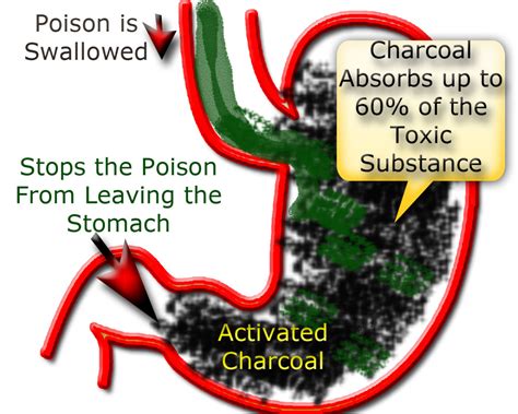 How to Administer Activated Charcoal for Accidental Poisonings - HubPages