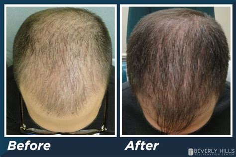 Low-level Laser Therapy Hair Loss Before After Buy Price | rbk.bm