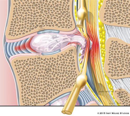 Custom designed Patient Education Illustrations: Medical Art