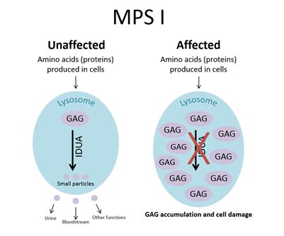 MPS I (Mucopolysaccharidosis Type I) – newbornscreening.info