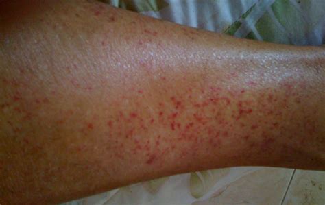 Varicose veins rash pictures | Symptoms and pictures