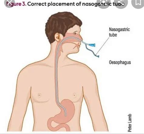 Nasogastric Tube Patient Care Services, Delhi in New Delhi | ID ...