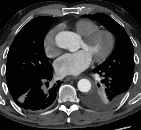 CT Case 034 • LITFL • CT scan interpretation