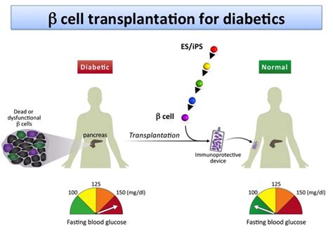 Stem cell diabetes cure