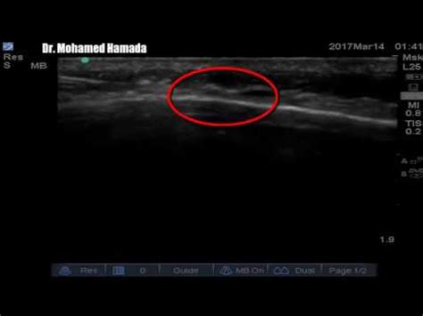 Ultrasound guided occipital nerve block in occipital neuralgia - YouTube