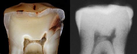 Diagnosis: Dental Caries. Dentine Caries