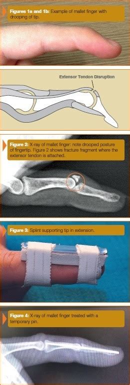 Mallet Finger Injuries New York | Hand Surgery Specialist New York