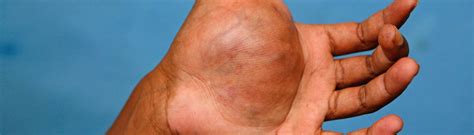 Neurofibromatosis | healthdirect