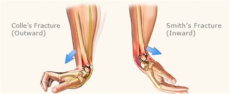 What is a Smith’s fracture? - Tanya Coats Occupational Therapy