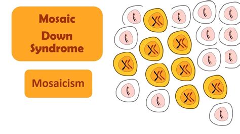 Mosaic Down Syndrome | Mosaicism | A type of Down Syndrome - YouTube