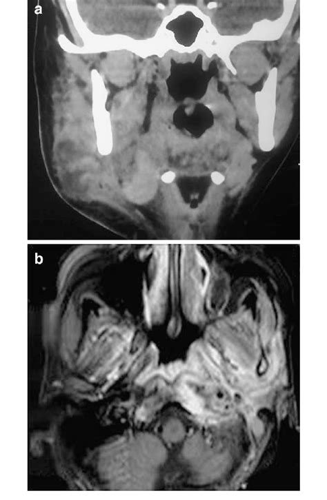 Masticator space infection: a coronal CT scan shows diffusely enlarged ...