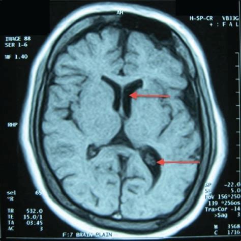 MRI brain plain. Arrows show prominence of ventricular | Open-i