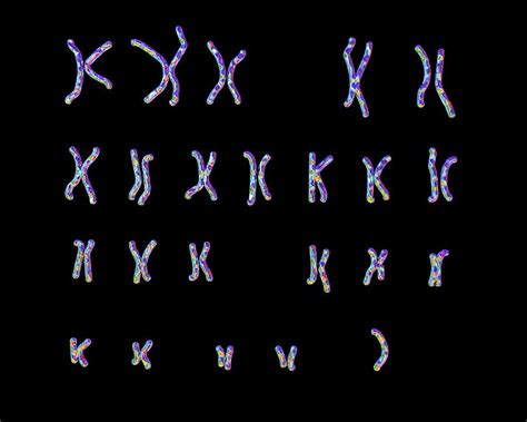 Turner's Syndrome Karyotype Photograph by Kateryna Kon/science Photo Library