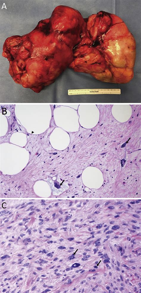 Giant Mediastinal Liposarcoma: A Rare Yet Distinct Clinical Entity - The Annals of Thoracic Surgery