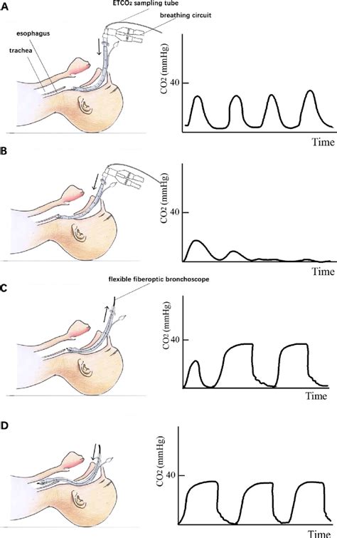 Steps for awake fibreoptic nasal intubation with the aid of end-tidal... | Download Scientific ...