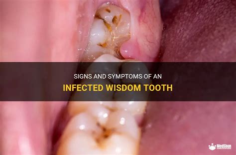 Signs And Symptoms Of An Infected Wisdom Tooth | MedShun