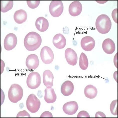 Hypogranular Platelets – Grey Platelet Syndrome | Medical Laboratories