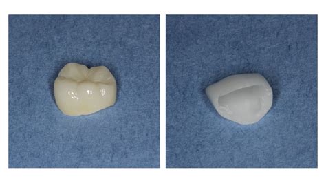 The Benefits of Zirconia Crowns – Rockside Family Dental Care