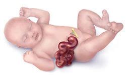 Pin on What is Gastroschisis?