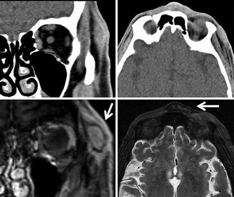 Top: CT scan. Non-specific soft tissue swelling temporal to the left... | Download Scientific ...