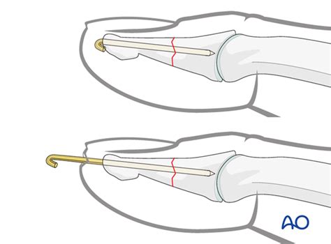 K-wire fixation for Distal phalanx, distal and shaft, transverse