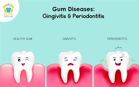 GUM DISEASES: GINGIVITIS & PERIODONTITIS | Elite Dental Care