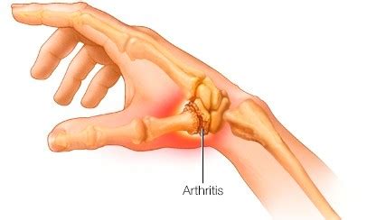 Thumb Arthritis, What Do I Do About It? Ohmyarthritis.com Updated 2024