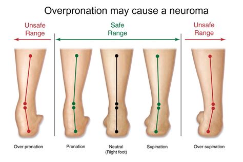 Over the counter drugs for plantar warts, inserts for overpronation running, pedag viva orthotic ...