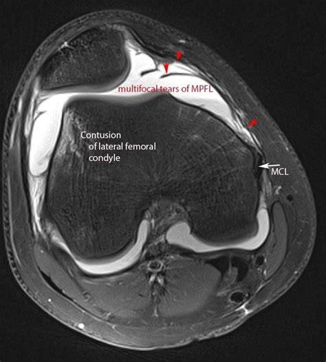 MRI NEWSLETTER: Patella Dislocation - Radius Imaging