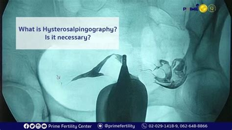 What is Hysterosalpingography? /PRIME FERTILITY CENTER