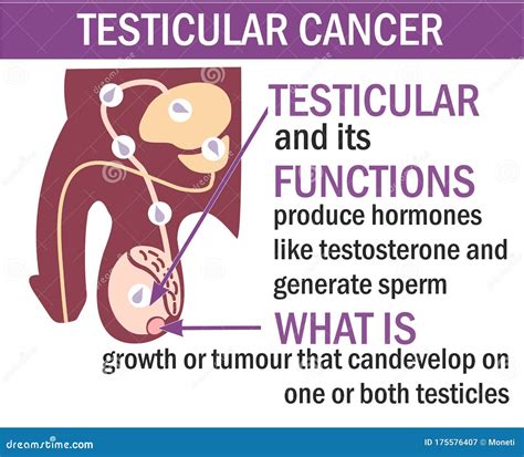 A Male Anatomy of Testicular Cancer Illustration. Testicular Cancer ...