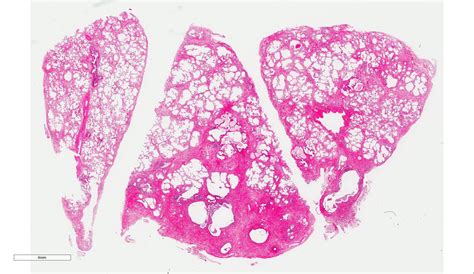 Interstitial Pneumonia Histology