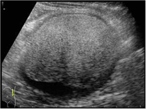 Abdomen and retroperitoneum | 1.7 Peritoneum mesentery and omentum ...