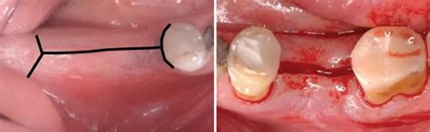 Description Of The Dental Implant Procedure