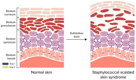 Staphylococcal Scalded Skin Syndrome (SSSS) (Clinical) | Concise ...