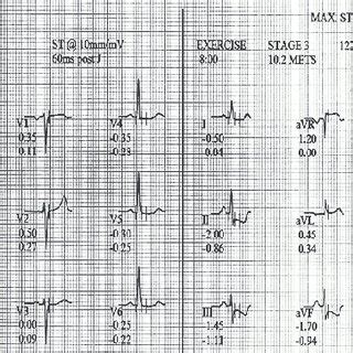 Exercise test-visible ST segment depression in II, III, aVF, V4-V6 leads. | Download Scientific ...