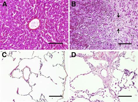 Understanding the Similarities and Differences between Hepatic and ...