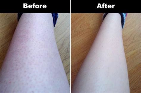 Razor bumps is the most irritating thing to have on body. Try to remove them in the easiest and ...